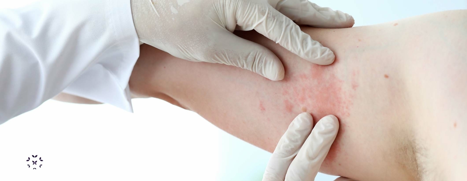 Lupus and Infections Kaleidoscope Fighting Lupus