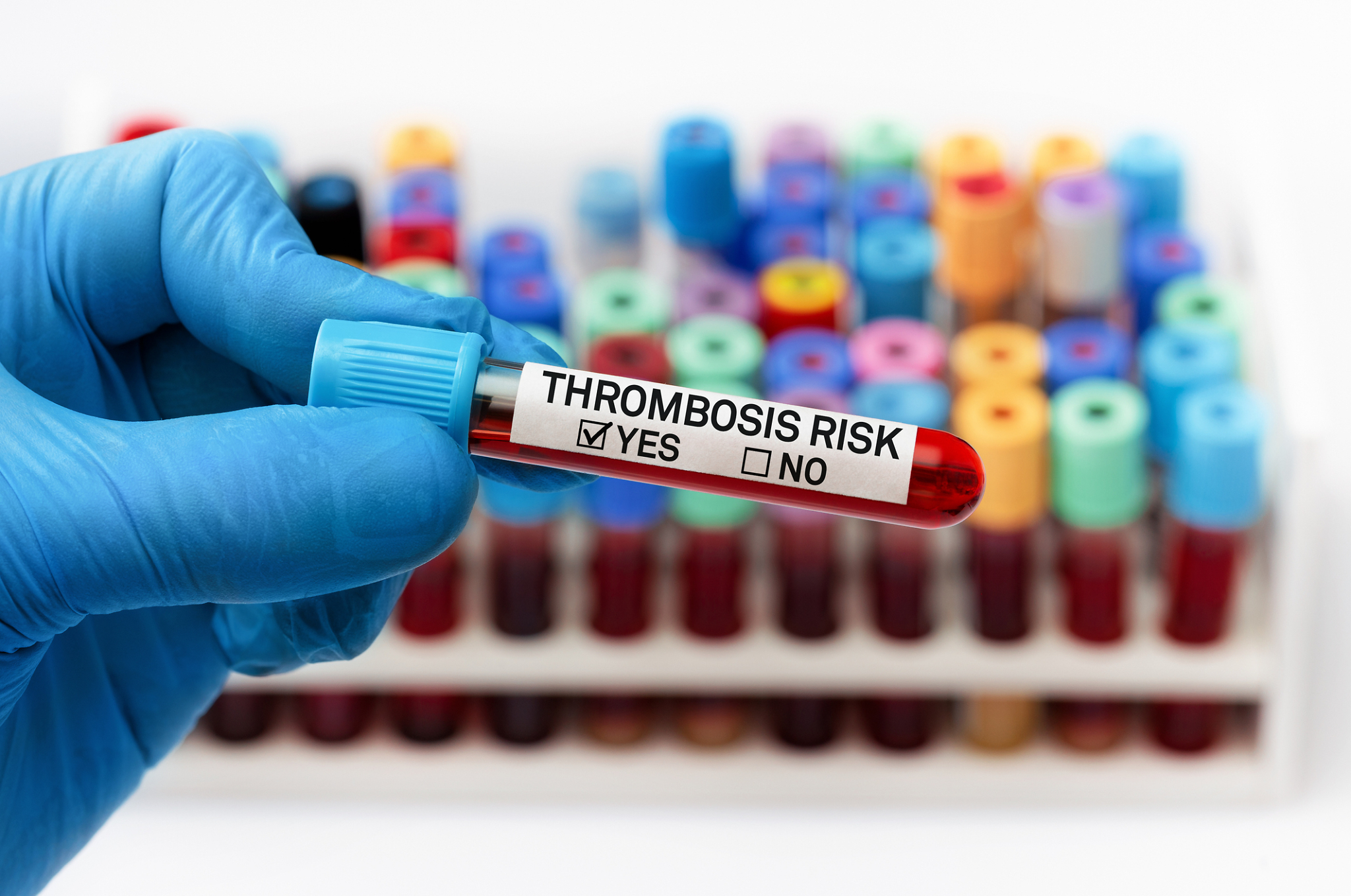 Blood sample test with positive diagnosis of Thrombosis risk in a