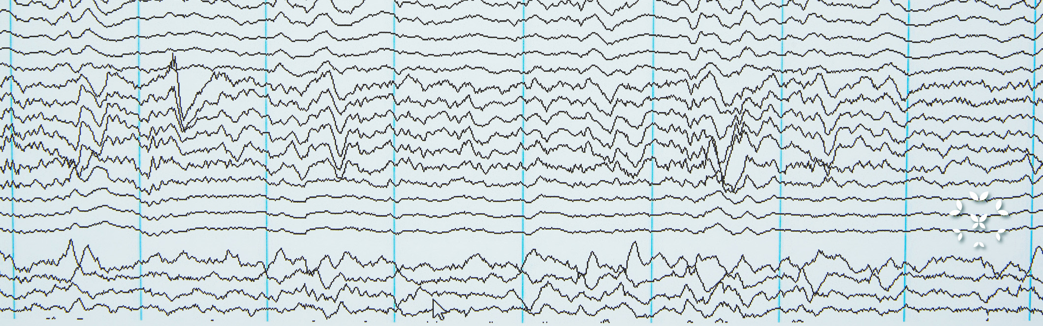 Lupus and Seizures Kaleidoscope Fighting Lupus